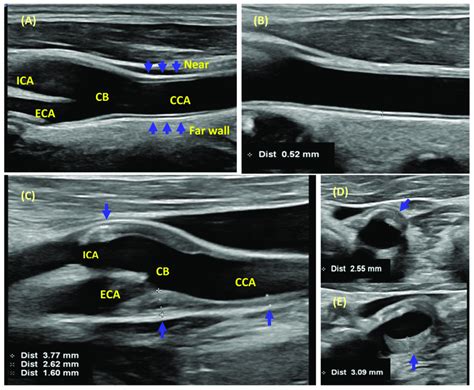 carotid intima media thickness measurement|cimt test vs carotid ultrasound.